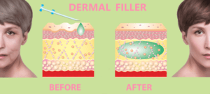Dermal filler with acrylic microspheres