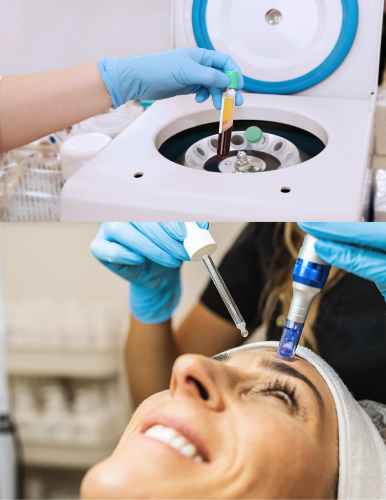 PRP and Microneedling